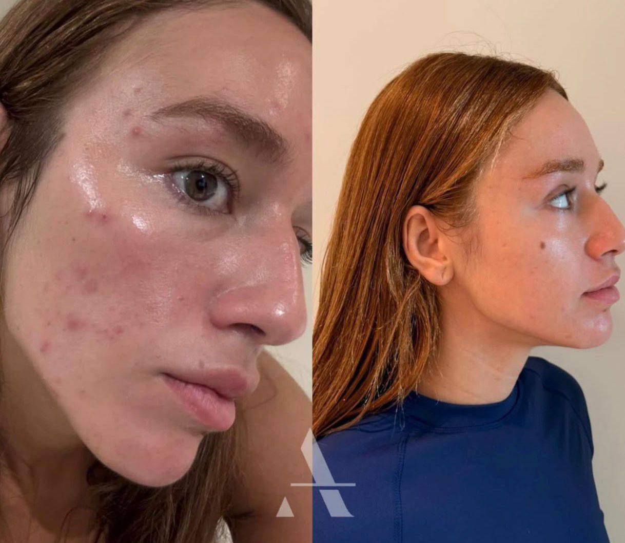 Acne treatment at AD Lisbon clinic