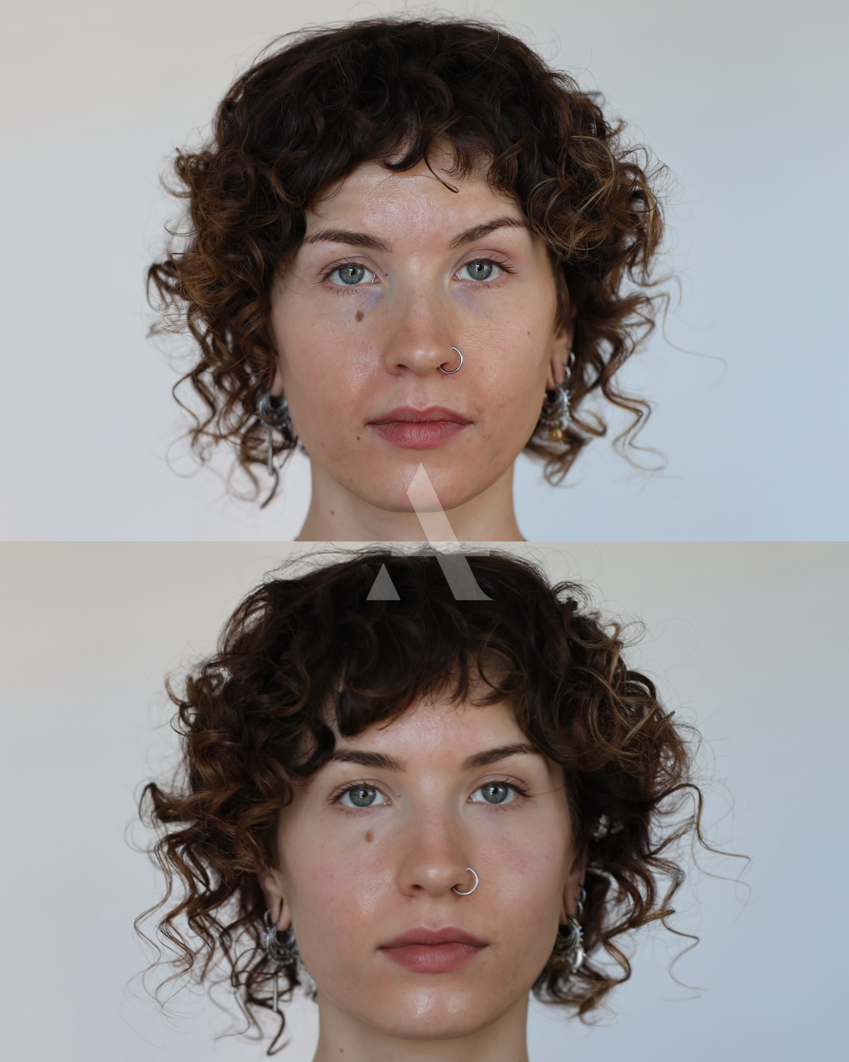 Dermal Filler Injectables treatment at AD Lisbon clinic